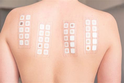 scratch test dermatology|positive allergy skin test.